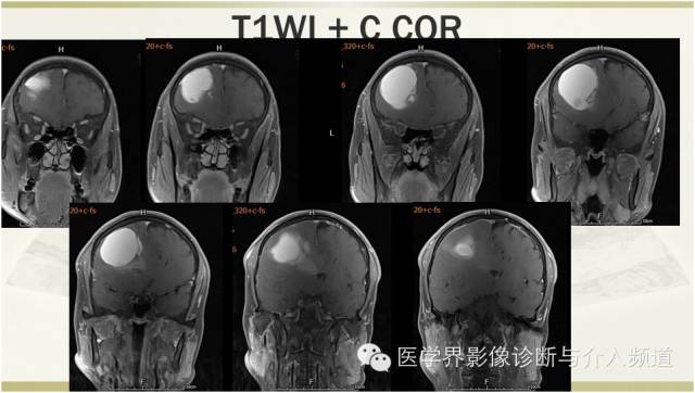 【病例】颅内转移瘤1例MR影像表现 【病例】颅内转移瘤1例MR影像表现