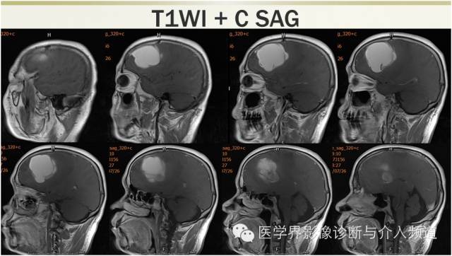 【病例】颅内转移瘤1例MR影像表现 【病例】颅内转移瘤1例MR影像表现