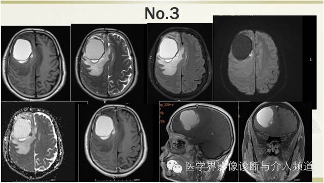 【病例】颅内转移瘤1例MR影像表现 【病例】颅内转移瘤1例MR影像表现