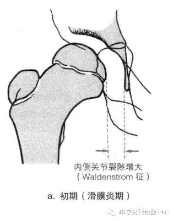 图解股骨头缺血坏死分期及分型