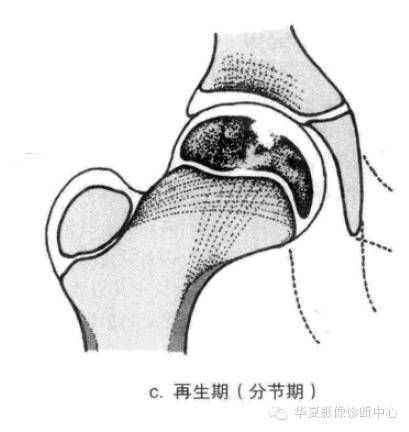 图解股骨头缺血坏死分期及分型
