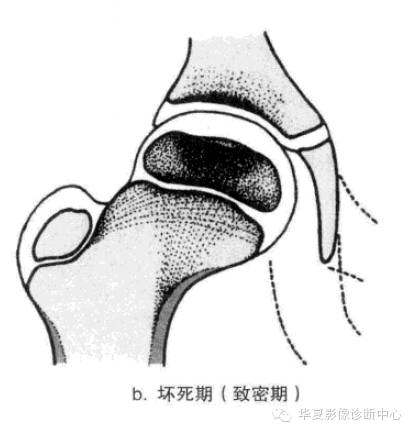 图解股骨头缺血坏死分期及分型