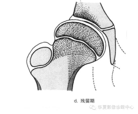 图解股骨头缺血坏死分期及分型