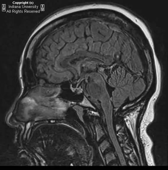 【病例】垂体卒中1例MR影像表现 【病例】垂体卒中1例MR影像表现