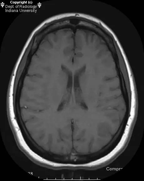 【病例】垂体卒中1例MR影像表现 【病例】垂体卒中1例MR影像表现