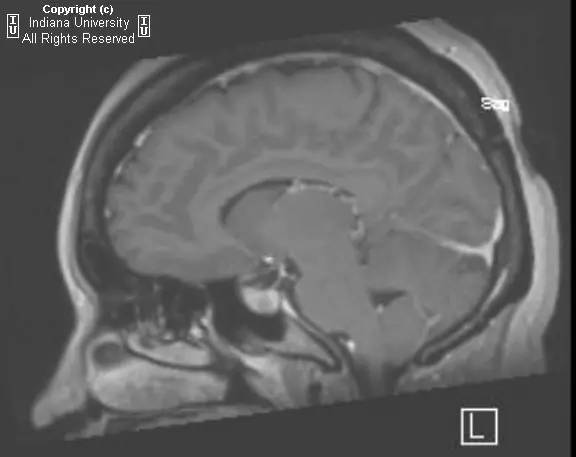 【病例】垂体卒中1例MR影像表现 【病例】垂体卒中1例MR影像表现