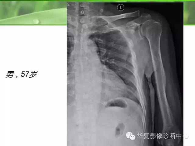 X线读片基础——肩周炎
