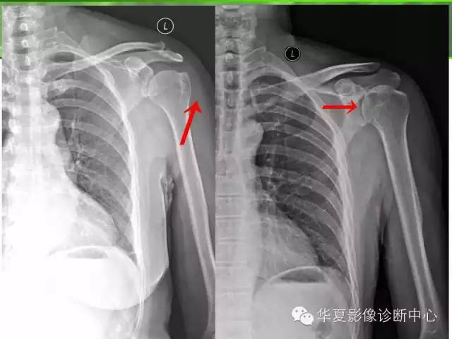 X线读片基础——肩周炎
