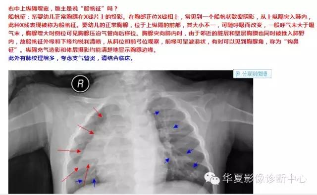 一张胸片看懂“船帆征”