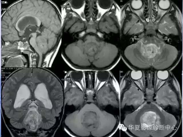 【病例】室管膜瘤1例MR影像表现