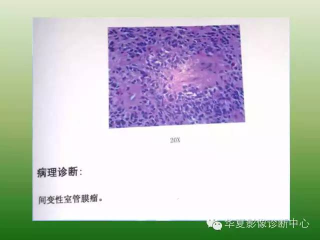 【病例】室管膜瘤1例MR影像表现