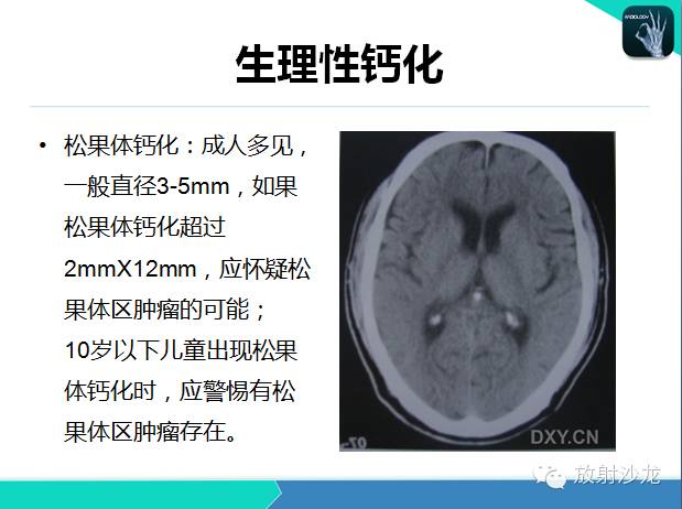 【PPT】颅内钙化常见疾病影像诊断