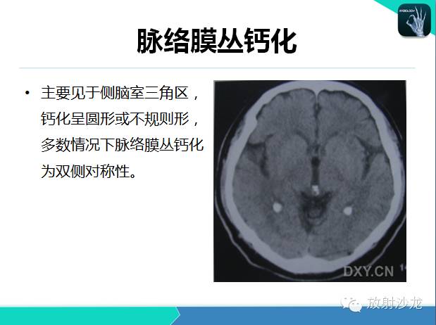 【PPT】颅内钙化常见疾病影像诊断