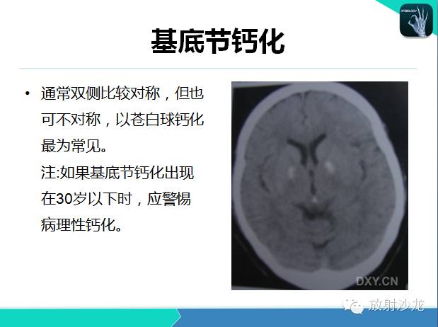 【PPT】颅内钙化常见疾病影像诊断