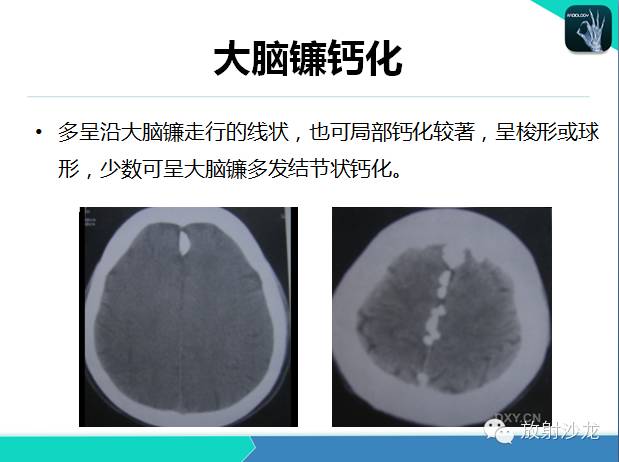 【PPT】颅内钙化常见疾病影像诊断