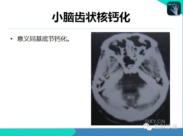 【PPT】颅内钙化常见疾病影像诊断