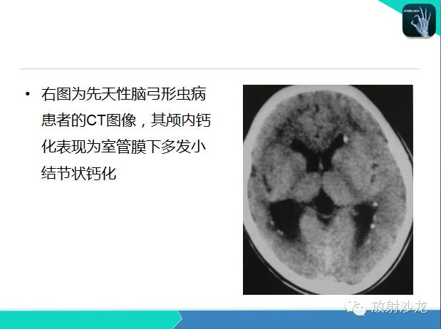 【PPT】颅内钙化常见疾病影像诊断