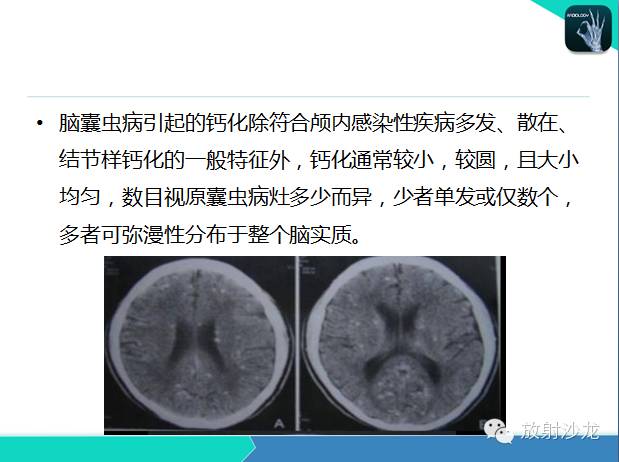【PPT】颅内钙化常见疾病影像诊断