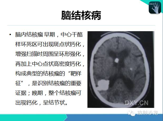 【PPT】颅内钙化常见疾病影像诊断