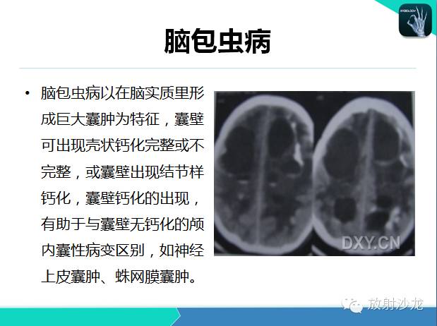 【PPT】颅内钙化常见疾病影像诊断