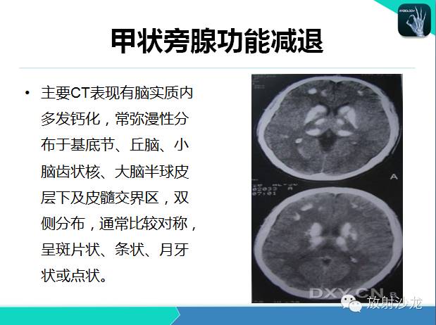 【PPT】颅内钙化常见疾病影像诊断