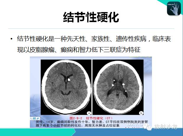 【PPT】颅内钙化常见疾病影像诊断