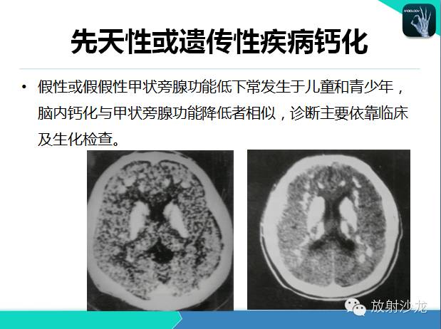 【PPT】颅内钙化常见疾病影像诊断