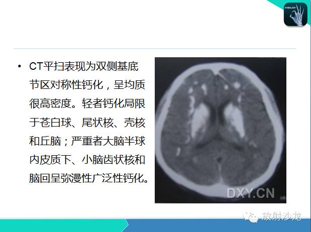 【PPT】颅内钙化常见疾病影像诊断