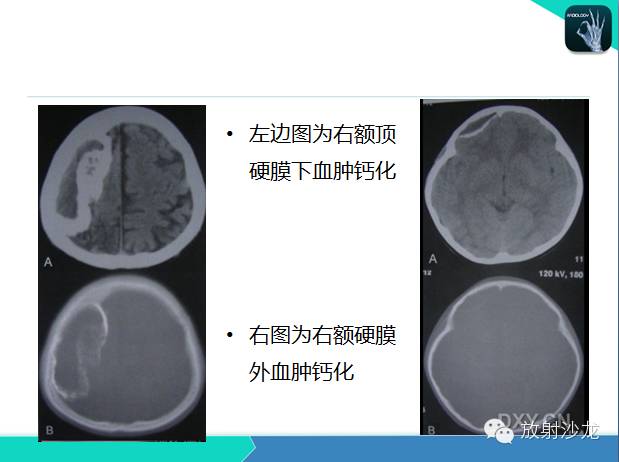 【PPT】颅内钙化常见疾病影像诊断