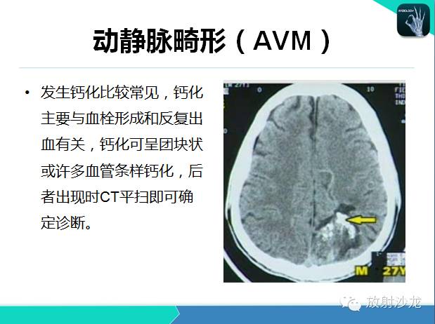 【PPT】颅内钙化常见疾病影像诊断