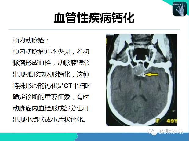 【PPT】颅内钙化常见疾病影像诊断