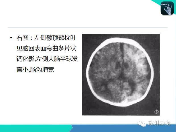 【PPT】颅内钙化常见疾病影像诊断