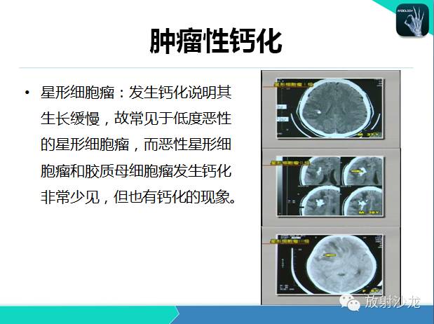 【PPT】颅内钙化常见疾病影像诊断