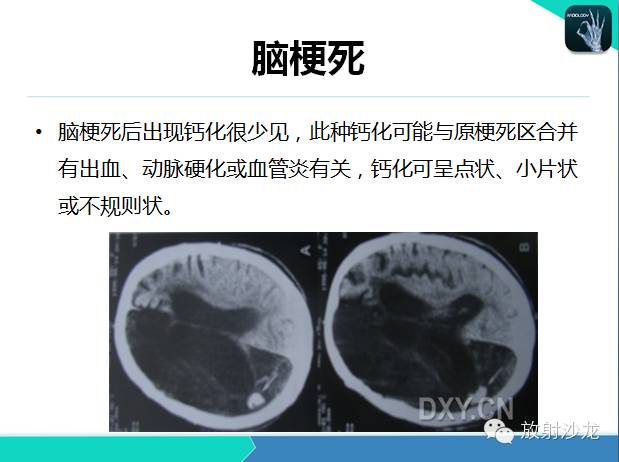 【PPT】颅内钙化常见疾病影像诊断