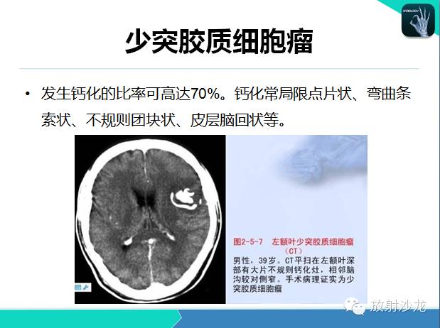 【PPT】颅内钙化常见疾病影像诊断