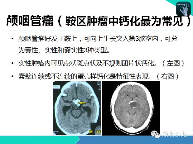 【PPT】颅内钙化常见疾病影像诊断