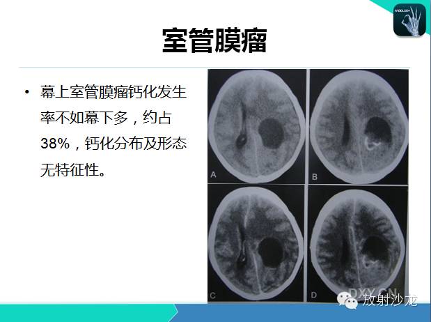 【PPT】颅内钙化常见疾病影像诊断