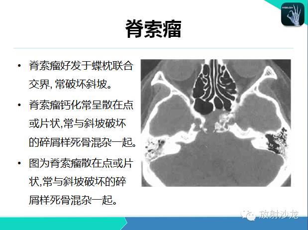 【PPT】颅内钙化常见疾病影像诊断