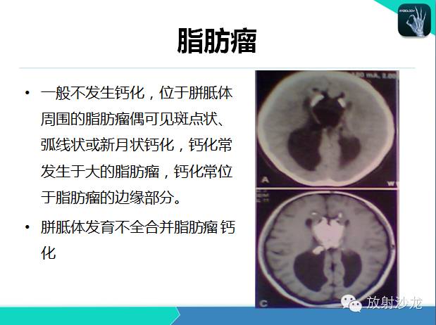 【PPT】颅内钙化常见疾病影像诊断
