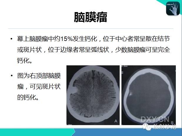 【PPT】颅内钙化常见疾病影像诊断