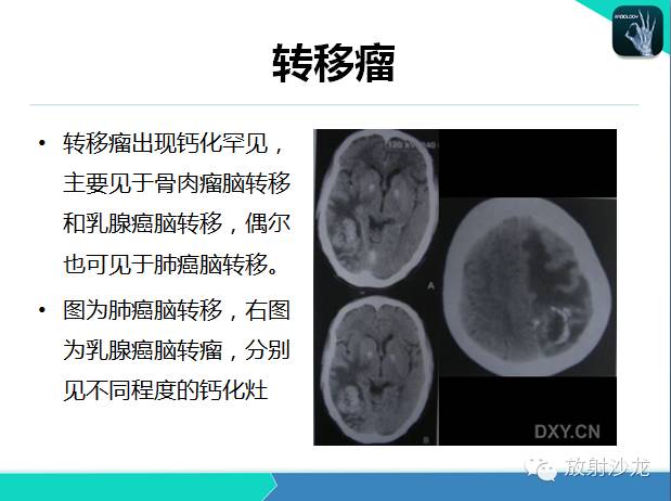【PPT】颅内钙化常见疾病影像诊断