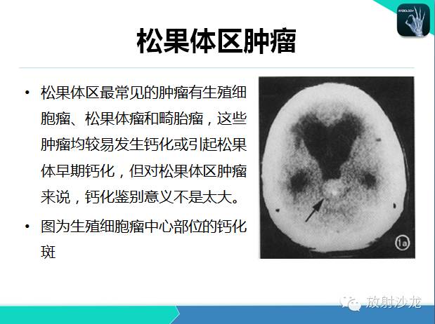 【PPT】颅内钙化常见疾病影像诊断