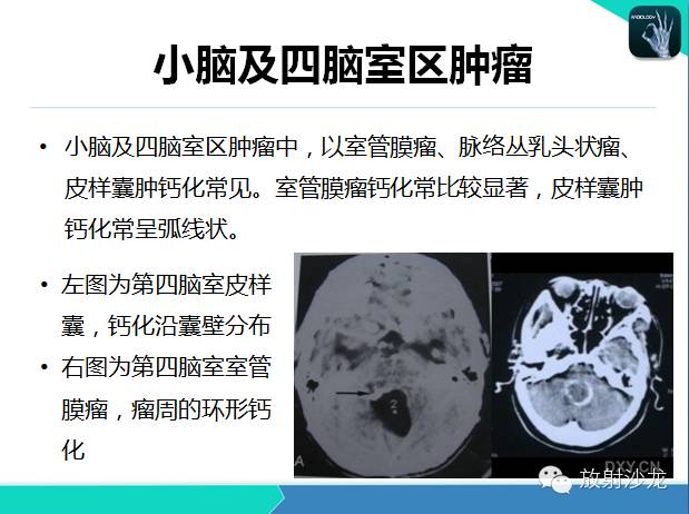 【PPT】颅内钙化常见疾病影像诊断