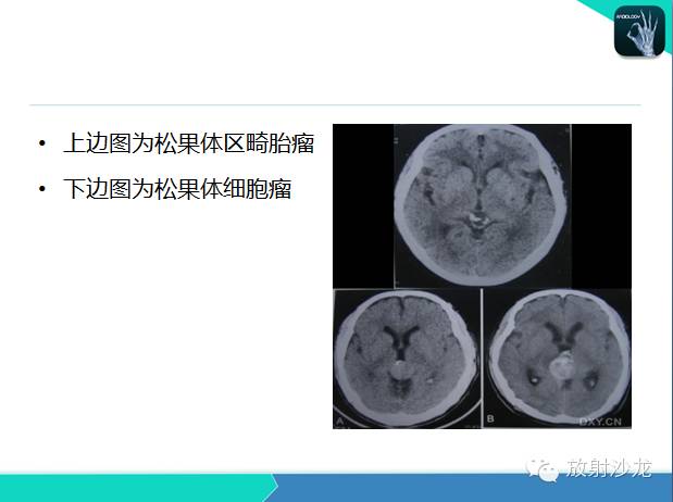 【PPT】颅内钙化常见疾病影像诊断