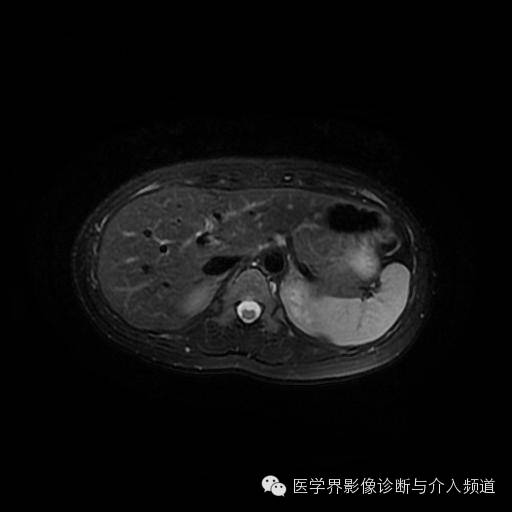 【病例】胰腺实性假乳头状瘤1例MR影像表现