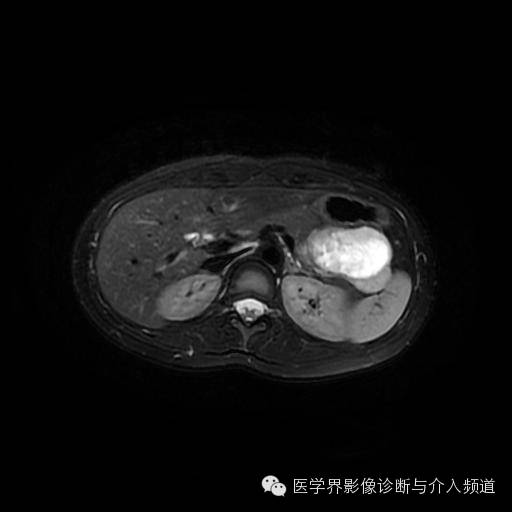 【病例】胰腺实性假乳头状瘤1例MR影像表现 【病例】胰腺实性假乳头状瘤1例MR影像表现