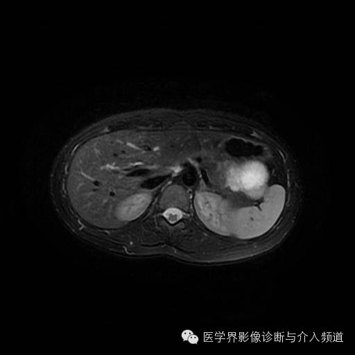 【病例】胰腺实性假乳头状瘤1例MR影像表现 【病例】胰腺实性假乳头状瘤1例MR影像表现