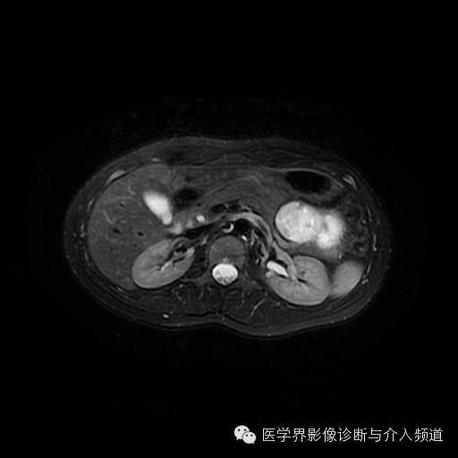 【病例】胰腺实性假乳头状瘤1例MR影像表现 【病例】胰腺实性假乳头状瘤1例MR影像表现