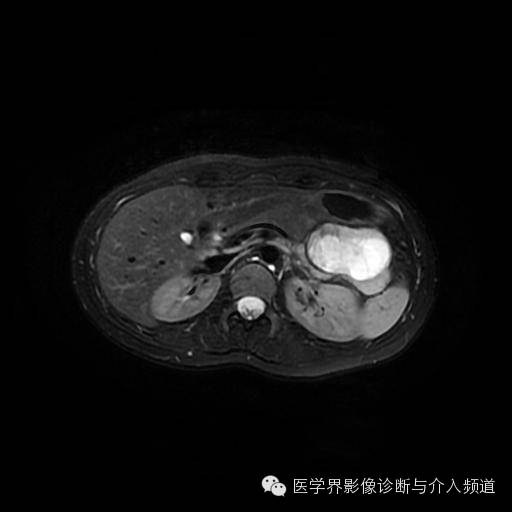 【病例】胰腺实性假乳头状瘤1例MR影像表现 【病例】胰腺实性假乳头状瘤1例MR影像表现