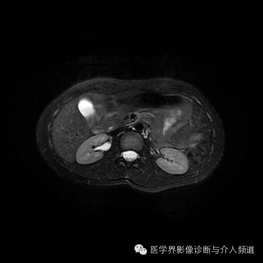 【病例】胰腺实性假乳头状瘤1例MR影像表现 【病例】胰腺实性假乳头状瘤1例MR影像表现